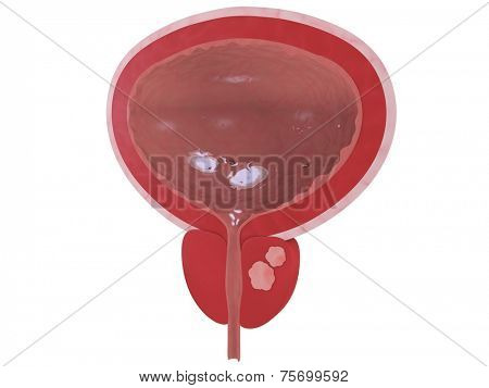 prostate cancer