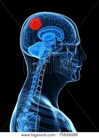 brain cancer