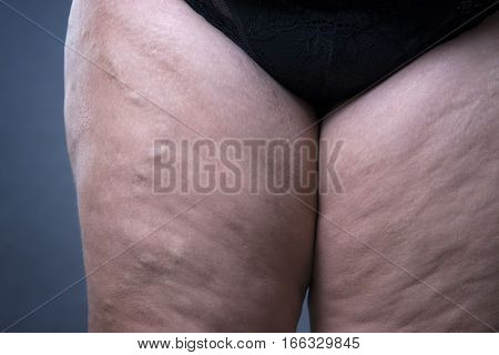 Varicose veins closeup thick female legs on a gray background