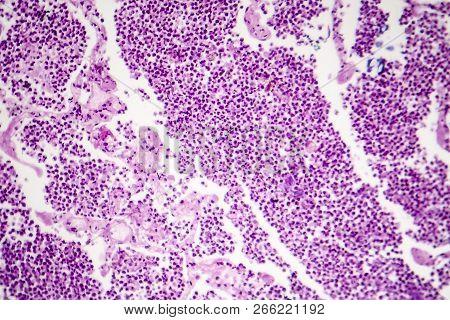Lobar Pneumonia, Gray Hepatic Phase, Light Micrograph, Photo Under Microscope