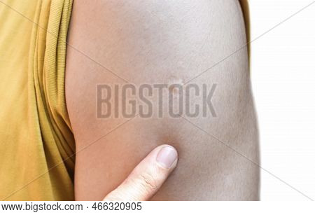 Bcg Or Tb Vaccine Scar Mark At The Arm Of Southeast Asian Man.