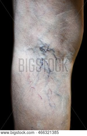 Prominent Veins Visible Through The Thin Skin Of Asian Old Woman.