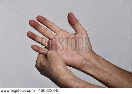 Cyanotic Hands Or Peripheral Cyanosis Or Blue Hands At Southeast Asian, Chinese Old Man