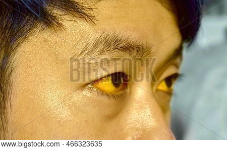 Deep Jaundice In Asian Male Patient. Yellowish Discoloration Of Skin And Sclera. Hyperbilirubinemia.