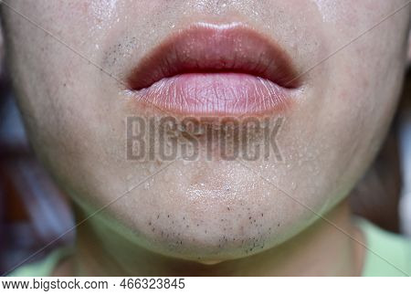 Excessive Sweating Or Hyperhidrosis And Oily Skin At Face Of Southeast Asian, Adult Young Man. Oily 