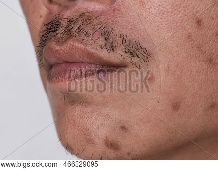 Small Brown Patches Called Age Spots And Scars On The Face Of Asian Man. Liver Spots, Senile Lentigo