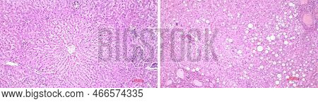 Light Microscopy Of The Liver. Comparison Of The Structure (histology) Of A Healthy Human Liver (lef