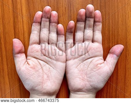 Cyanotic Hands Or Peripheral Cyanosis Or Blue Hands At Southeast Asian, Chinese Child With Congenita