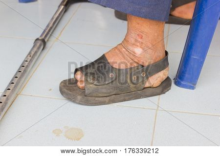 closeup feet of old asian man suffering from leprosy with a cane on the ground