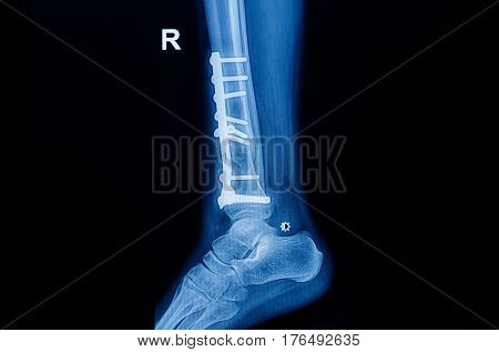 Fracture Ankle Fibula Bone ( Leg Bone ) X-ray Of Ankle With Plate And Screw