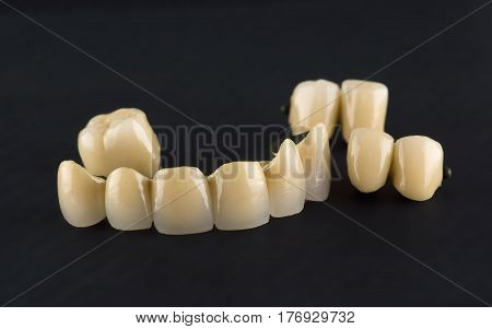 Metal-ceramic tooth crowns with locks for fixing removable prostheses