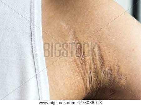 Stretch Marks On Armpit Skin Area Caused By Tearing Of The Dermis Layer Of The Skin, Selective Focus
