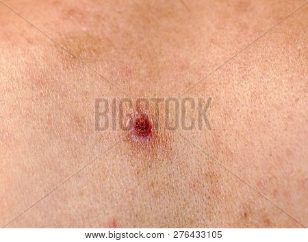 Torn Off A Bleeding Pimple On The Skin. Inflammation, Acne.