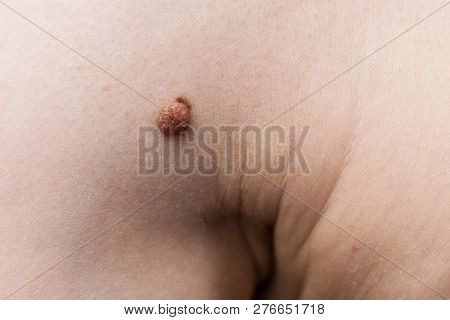 Unrecognizable Person Having Dark Fibroma, Dermatology Problem On Skin. Close Up Of Papilloma Dermat