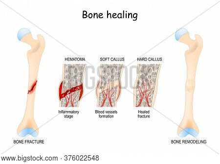 Bone Healing Process After A Bone Fracture. Stages Of Bone Healing. Vector Diagram