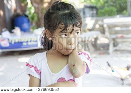 Asian Little Girl Using Mouth To Blow The Wound To Relieve Pain Due To An Accident.