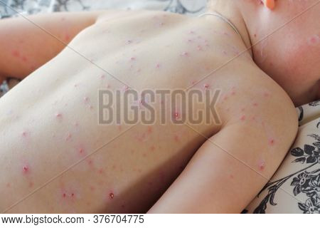 Close-up Of A Small Child With Chickenpox Virus Or Chickenpox Bubble In A Hurry