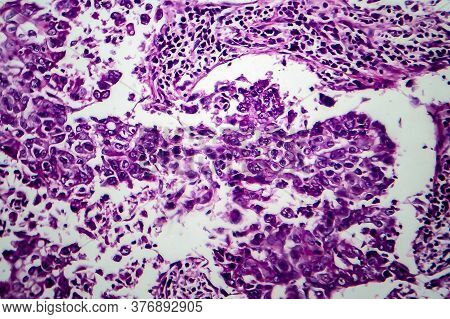 Breast Ductal Carcinoma, Light Micrograph, Photo Under Microscope