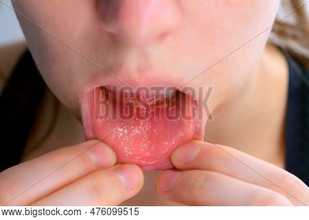Stomatitis In Womans Mouth After Dental Treatment Cure, Disease In The Mouth.