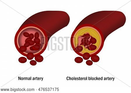 Cholesterol In Artery. Medical Concept, 3d Rendering