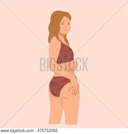 Young Woman In Underwear Is Upset Because Of Cellulite On Her Buttocks.