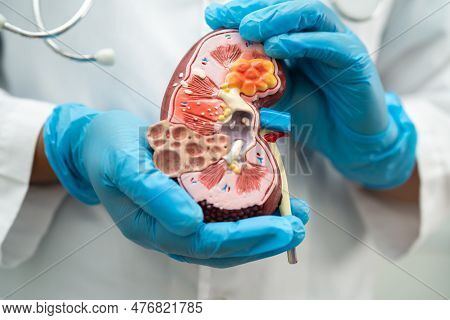 Kidney Disease, Chronic Kidney Disease Ckd, Doctor Hold Model To Study And Treat In Hospital.
