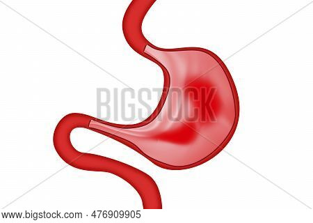 Gastroduodenitis. Inflammation Of The Mucous Membranes Of The Stomach And Duodenum, 3d Rendering