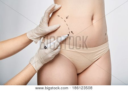 Surgery dotted line on body with marker