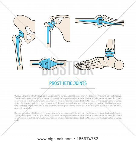 Vector banner on the theme of health, the health of human joints and methods of operative treatment by implantation. Vector illustration with place for text, isolated on white background