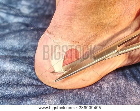 Nurse Help To Patient With Abrasion On The Skin On The Heel, Devastated Skin From Running Sports Sho