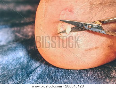 Nasty Burned Wound. Removing Of Burned Skin From Attached Place At Achilles Tendon.
