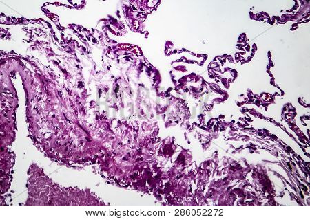 Histopathology Of Lung Emphysema, Light Micrograph, Photo Under Microscope Showing Enlargement Of Ai