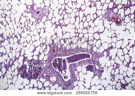 Histopathology Of Pneumonia, Light Micrograph, Photo Under Microscope