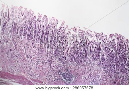 Histopathology Of Chronic Atrophic Gastritis, Light Micrograph, Photo Under Microscope