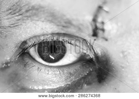 Eye Injury Bruises And Bruises. A Blow To The Eye
