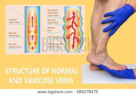 Varicose Veins On A Female Senior Legs. The Structure Of Normal And Varicose Veins. Concept Of Dry S