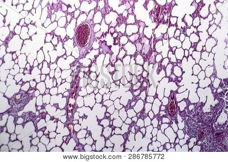 Histopathology Of Pneumonia, Light Micrograph, Photo Under Microscope