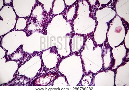 Histopathology Of Pneumonia, Light Micrograph, Photo Under Microscope. Cellulose Aspiration Pneumoni