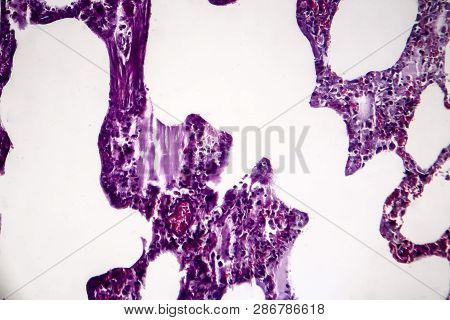 Histopathology Of Pneumonia, Light Micrograph, Photo Under Microscope. Cellulose Aspiration Pneumoni