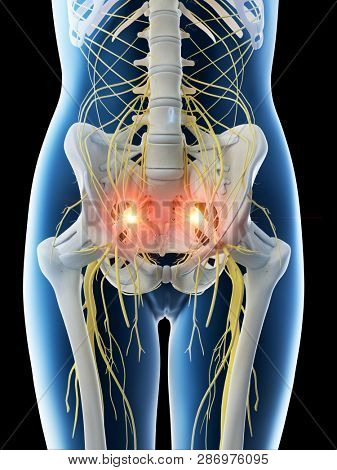 3d rendered illustration of a females painful sciatic nerve