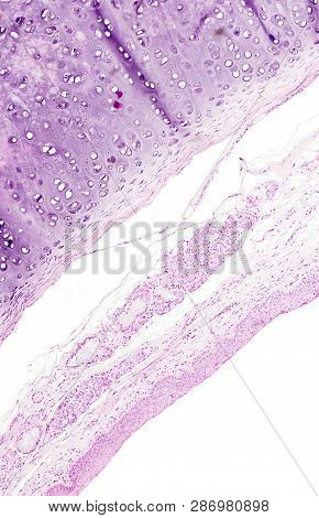 Histology Of Human Tissue, Show Squamous Metaplasia Of Bronchial Mucosa As Seen Under The Microscope