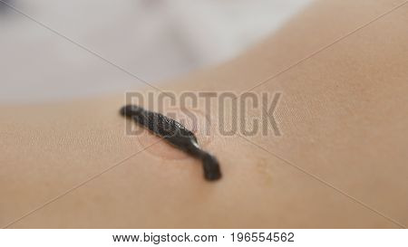 Leech on skin of blonde young woman - hirudotherapy - close up view