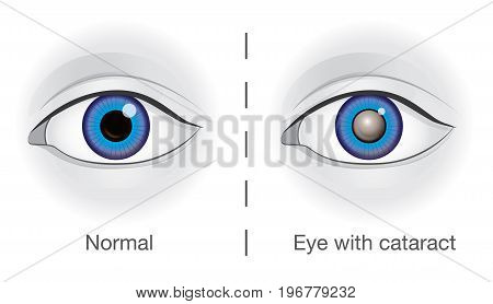 Normal eye and lens clouded by cataract. Illustration about health and eyesight.