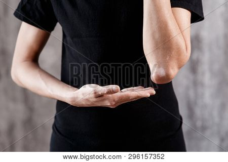 Vitiligo Close-up On The Hands And Elbows Of A Man