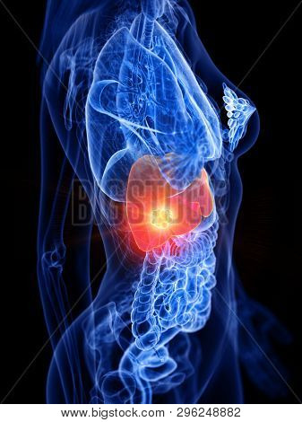 3d rendered medically accurate illustration of a womans liver tumor