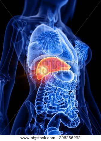 3d rendered medically accurate illustration of a womans liver tumor