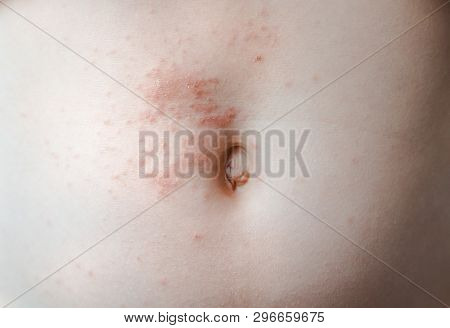 Chicken Pox Baby. The Varicella Zoster Virus Or Scabies Rash On The Child. The Concept Of Dermatolog