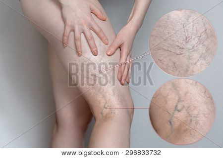 Woman Shows Leg With Varicose Veins. Magnifying The Image. The Concept Of Human Health And Disease.