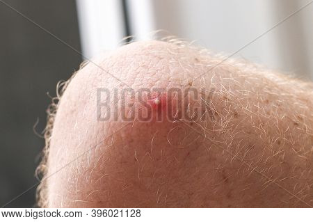 Fresh Ripe Pimple On A Mans Elbow. Unhealthy Skin.