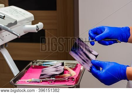 X-ray, The Dentist Holds An X-ray Of The Teeth, Assesses The Integrity Of The Teeth And Nerve Canals